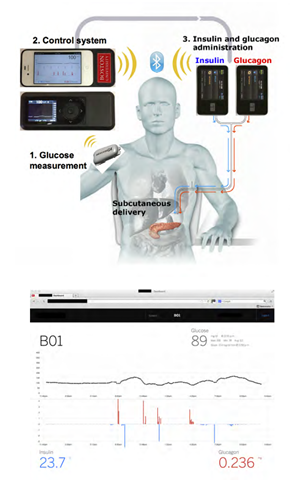 A diagram outlining the complete bionic pancreas system